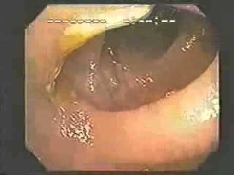 The Colon Hydrotherapy Procedure in Maui, Hawaii The Colon Hydrotherapy Procedure in Maui, Hawaii